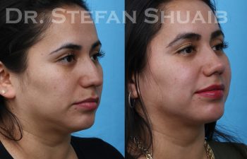 patient before and after rhinoplasty