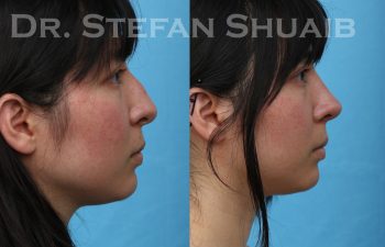 patient before and after rhinoplasty