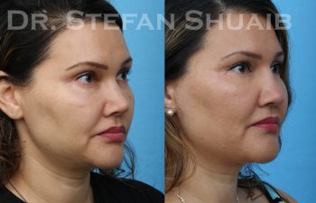 patient before and after revision rhinoplasty