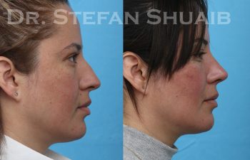 patient before and after rhinoplasty