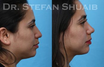 patient before and after rhinoplasty