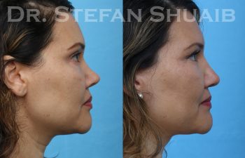 patient before and after revision rhinoplasty