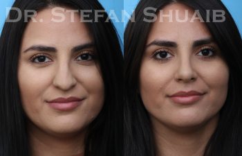 patient before and after rhinoplasty