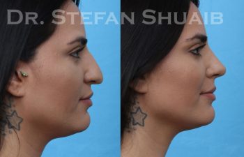 patient before and after rhinoplasty